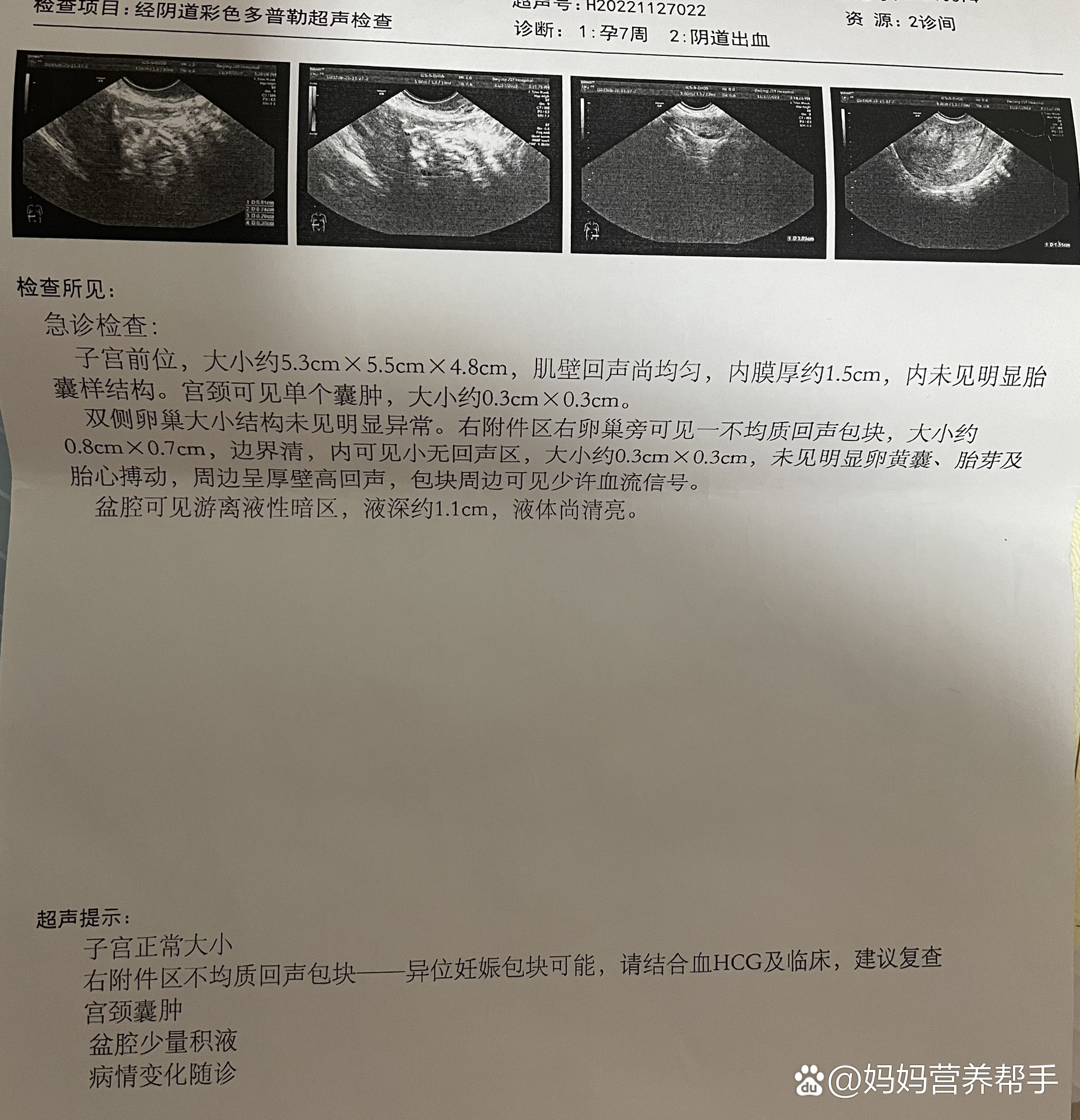 宫外孕hcg值的范围-(宫外孕hcg值的范围多少不用吃药)