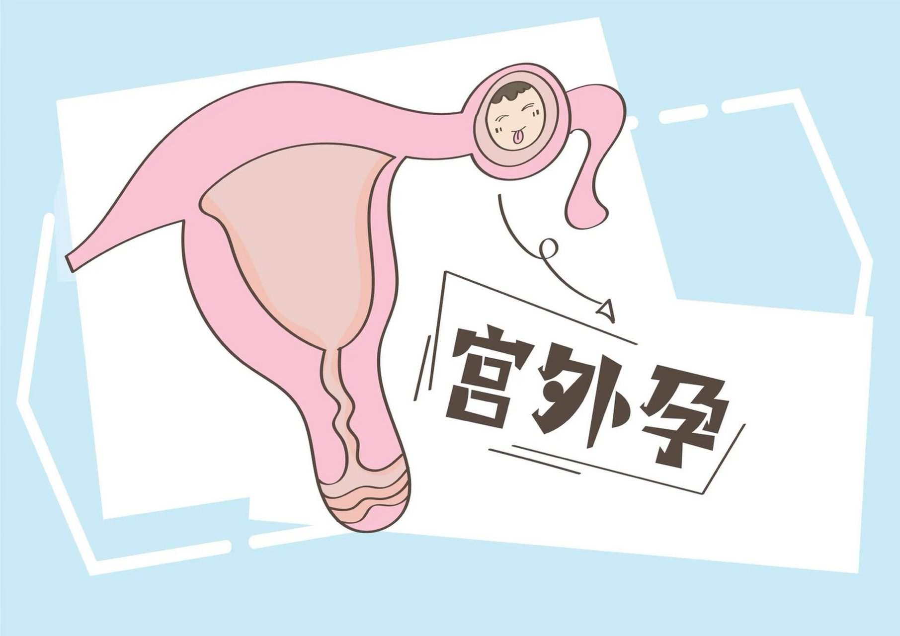 宫外孕怎么治疗-(刚发现宫外孕怎么治疗)