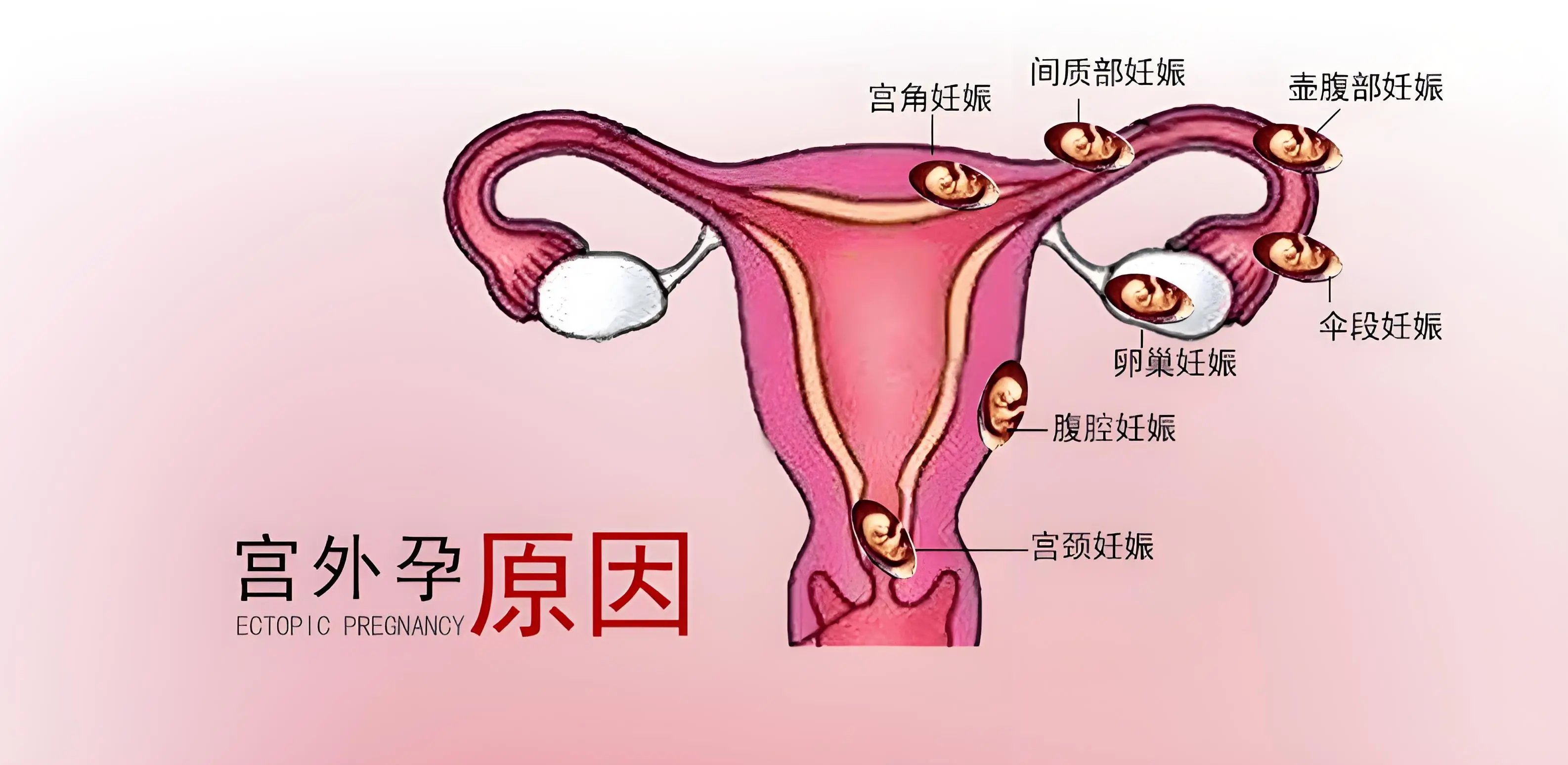 宫外孕是怎么引起的_(宫外孕是怎么引起的 跟男的原因)