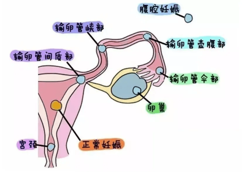宫外孕危险性大吗-(子宫外怀孕有什么症状)