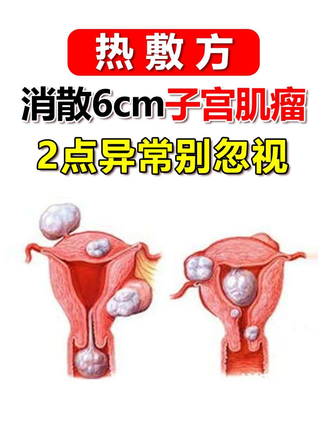 子宫肌瘤(子宫肌瘤严重吗会有什么后果)