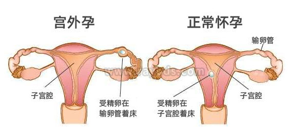 宫外孕是什么-(宫外孕是什么引起的)