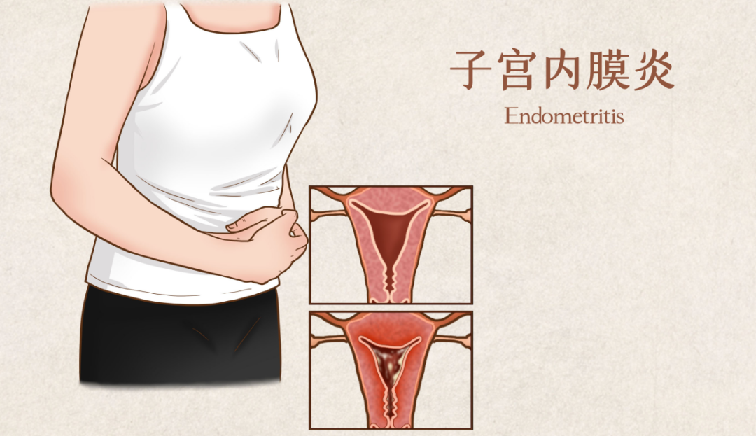 子宫内膜_(子宫内膜癌b超能看出来吗)