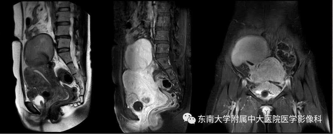 子宫内膜异位症_(子宫内膜异位症能怀上孩子吗)