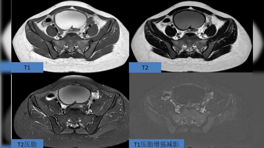 子宫内膜异位症_(子宫内膜异位症能怀上孩子吗)