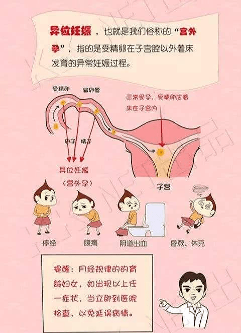 宫外孕有什么症状(同房六天宫外孕有什么症状)