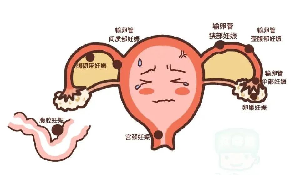 宫外孕肚子疼的位置图_(宫外孕肚子疼位置图详解)