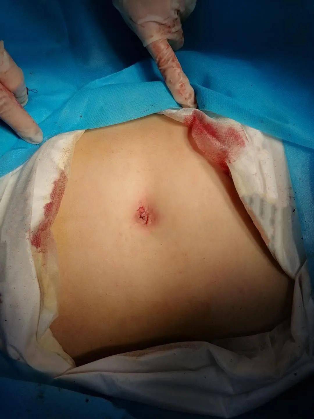 宫外孕腹腔镜手术_(宫外孕腹腔镜手术后多久可以同房)