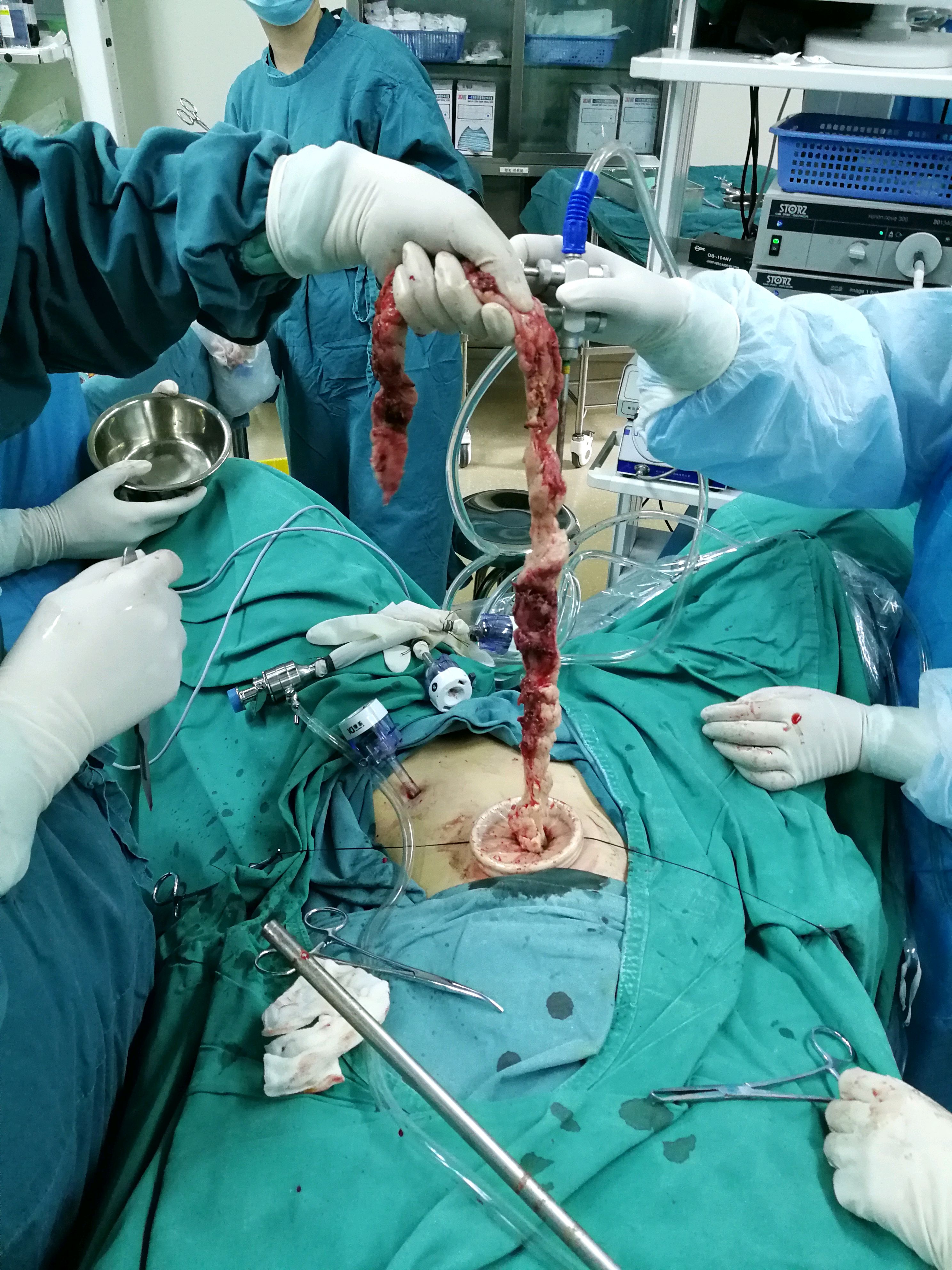 宫外孕腹腔镜手术_(宫外孕腹腔镜手术后多久可以同房)