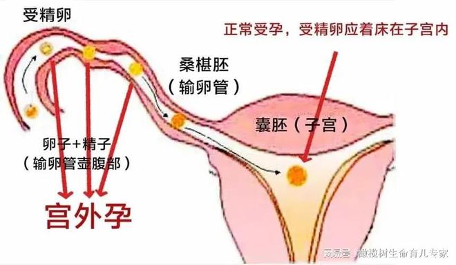 宫外孕需要切除输卵管吗(宫外孕需要切除输卵管吗有包块)