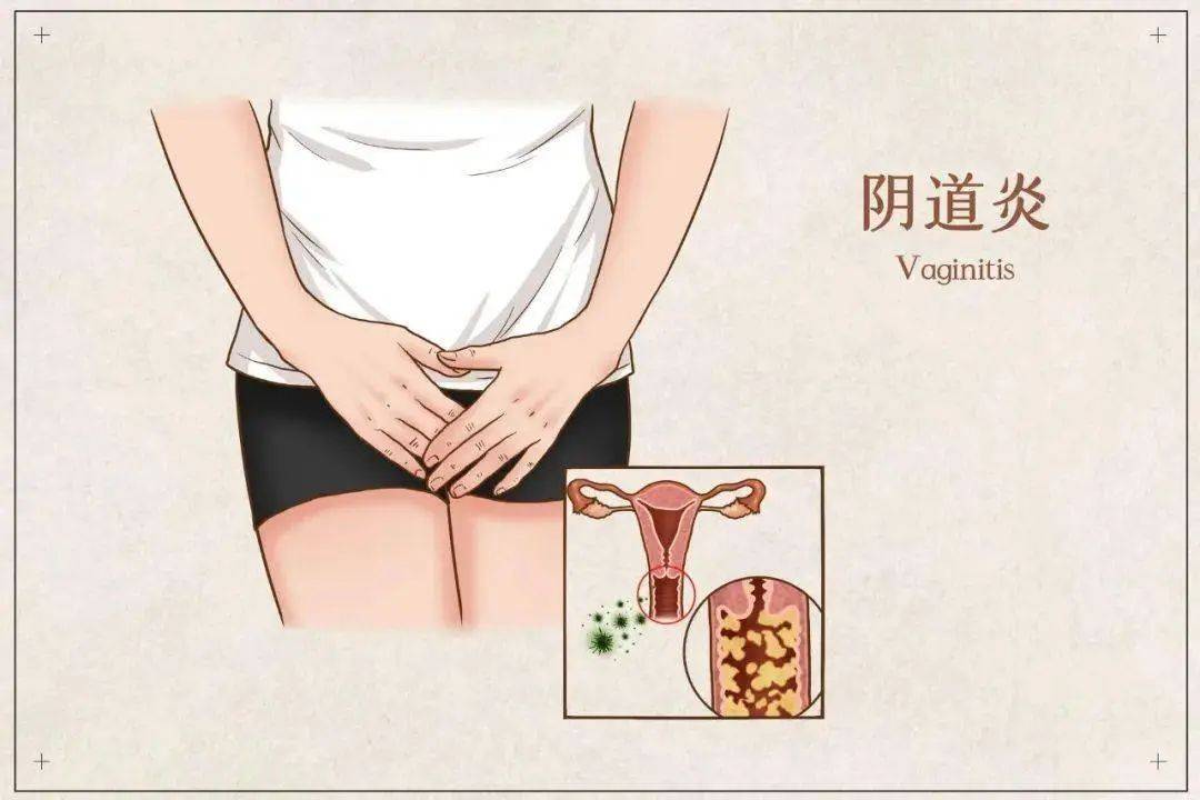 细菌性阴炎一直治不好_(细菌性阴炎一直治不好反反复复私处瘙痒长豆)