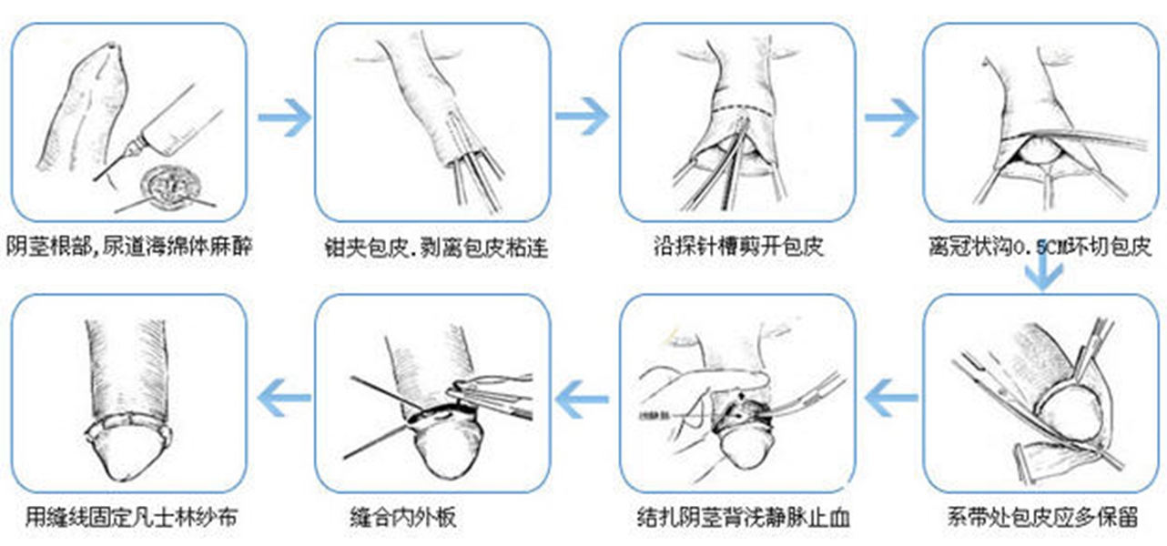 包皮过长图片-(包皮过长图片示意图)