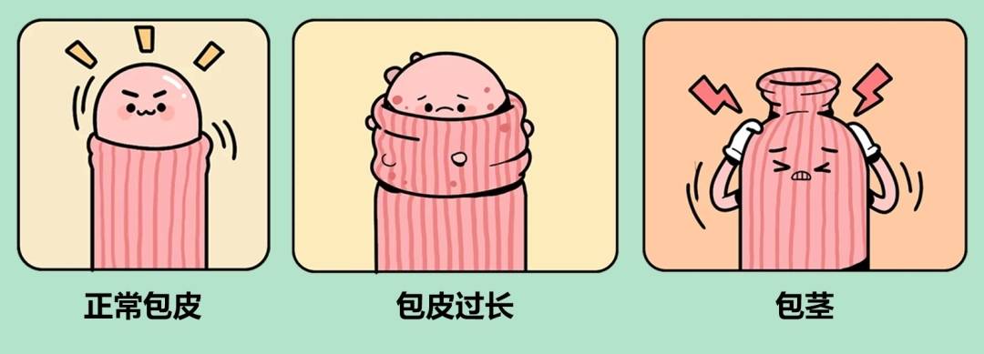 包皮过长图片-(包皮过长图片示意图)