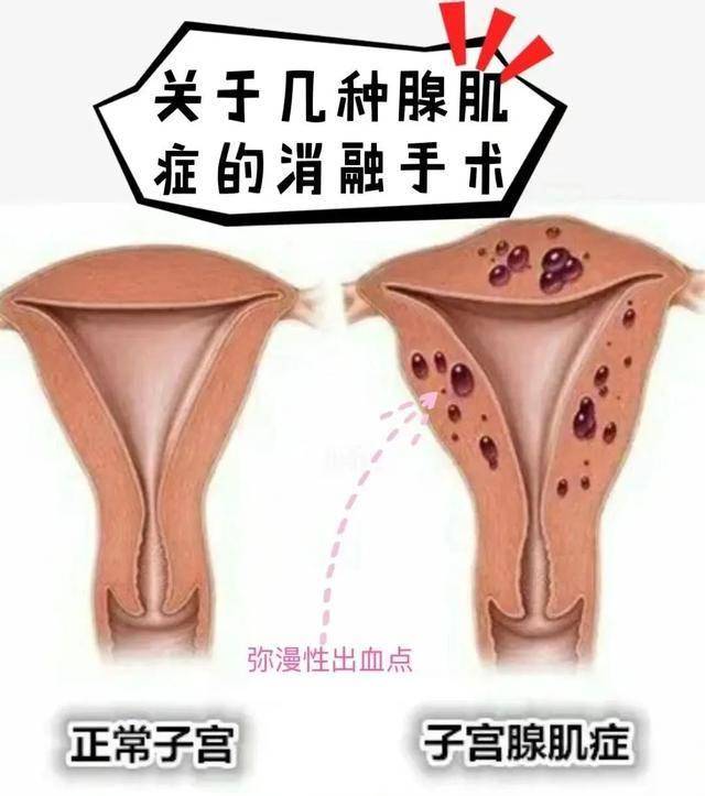 子宫腺肌症_(子宫腺肌症可以怀孕吗)