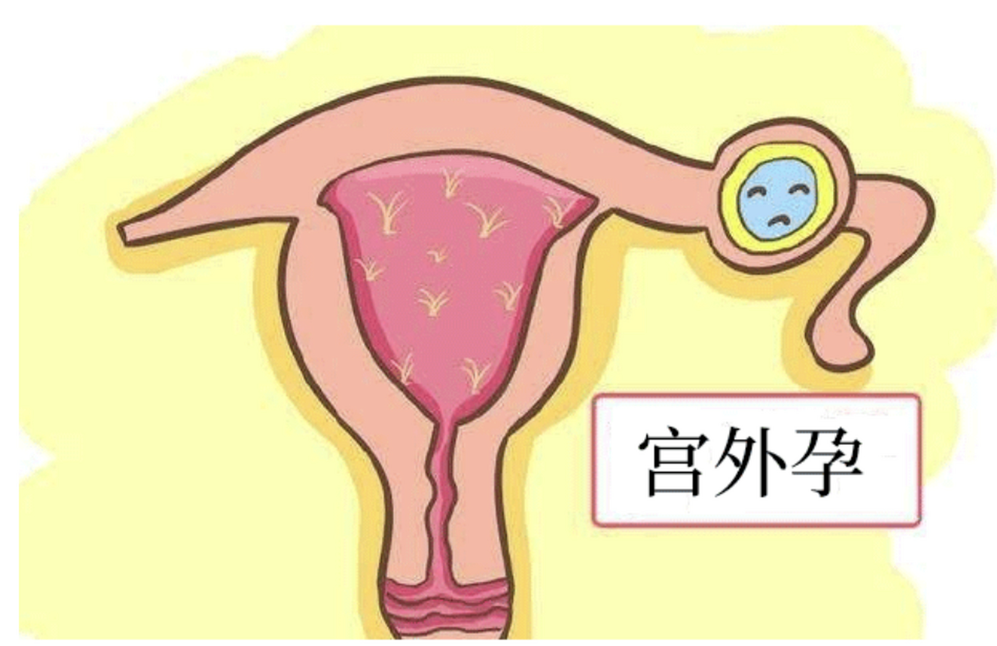 为什么会宫外孕(没有性生活为什么会宫外孕)