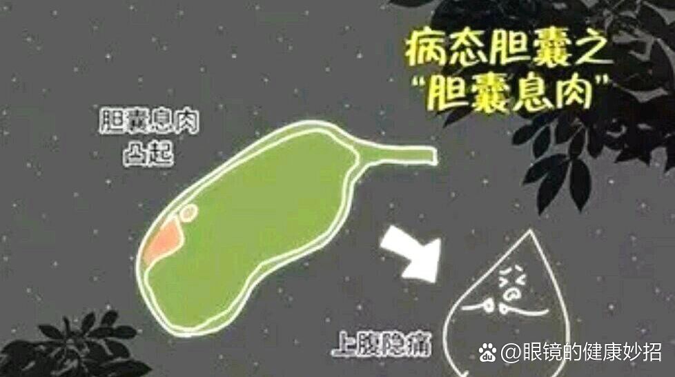 胆囊息肉饮食注意事项-(胆囊息肉饮食注意事项 知乎)