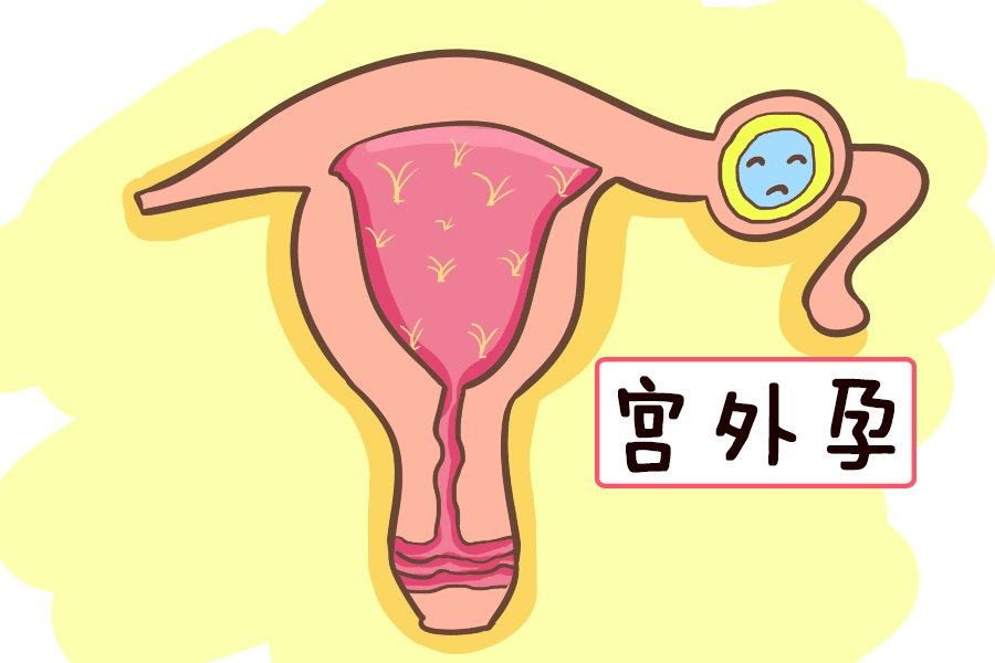 什么是宫外孕-(什么是宫外孕有什么症状)