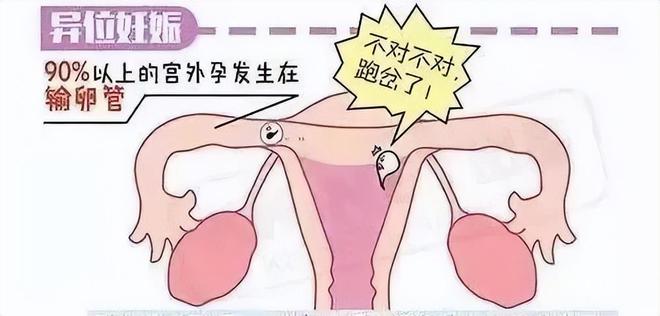 宫外孕是什么意思(陈旧性宫外孕是什么意思)