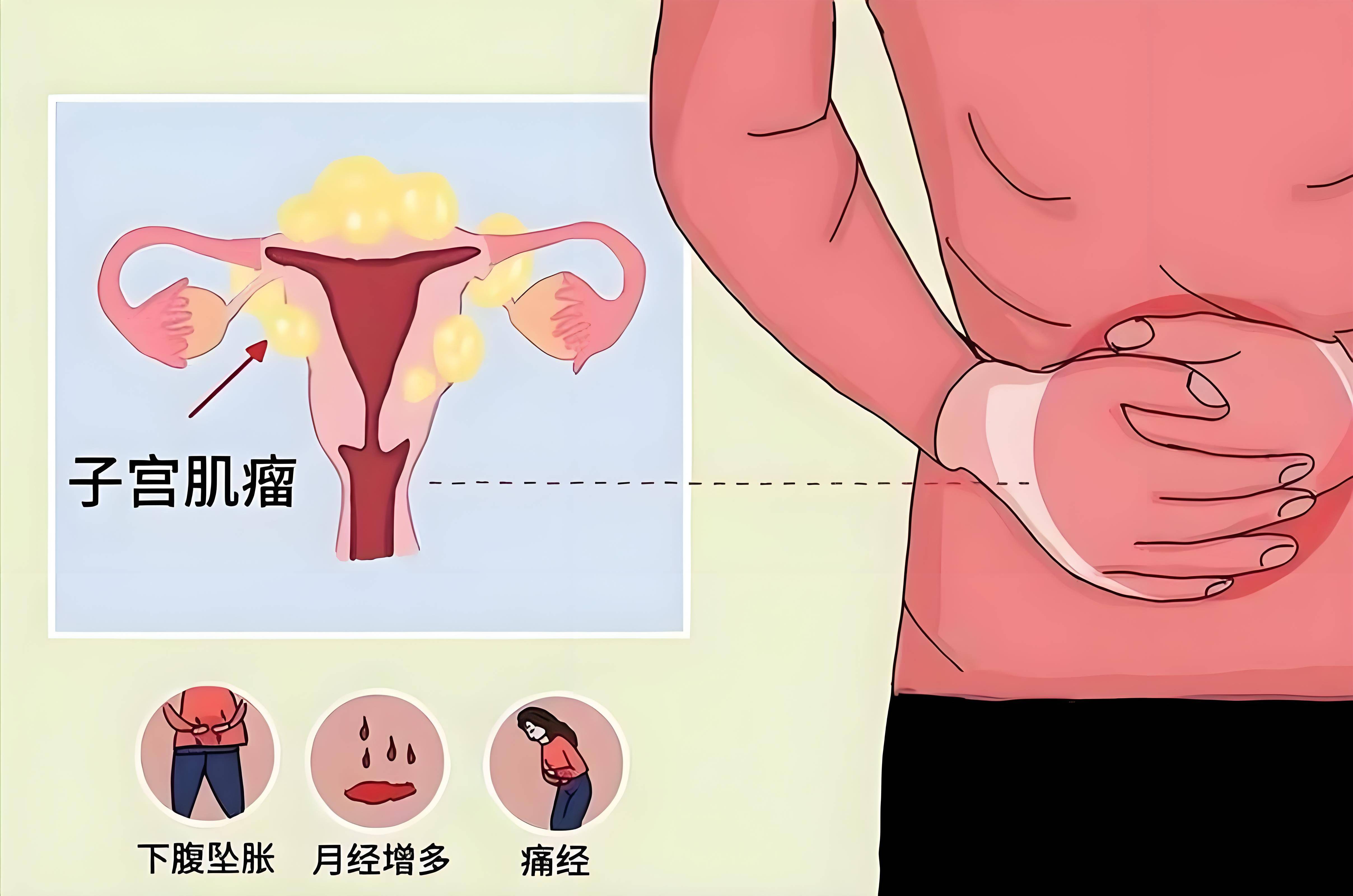 子宫肌瘤多大必须手术切除-(子宫肌瘤多大必须手术切除需要休息多久)