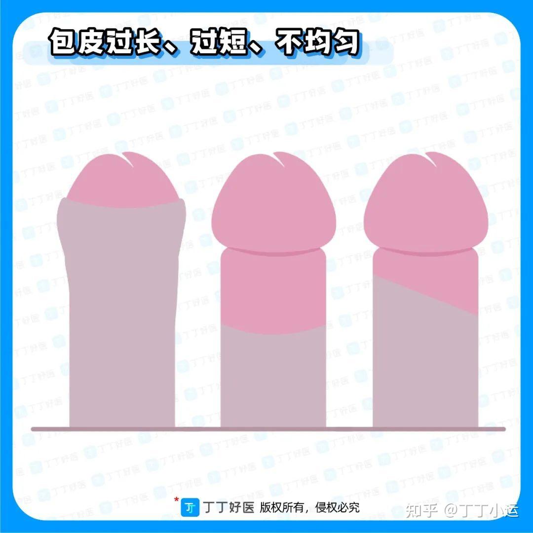 包皮包茎(包皮包茎挂什么科儿童)