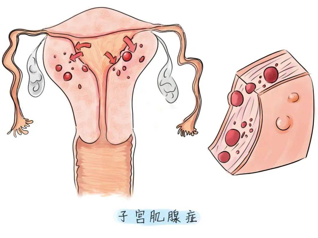 子宫腺肌症是什么意思-(子宫腺肌症是什么意思严不严重)