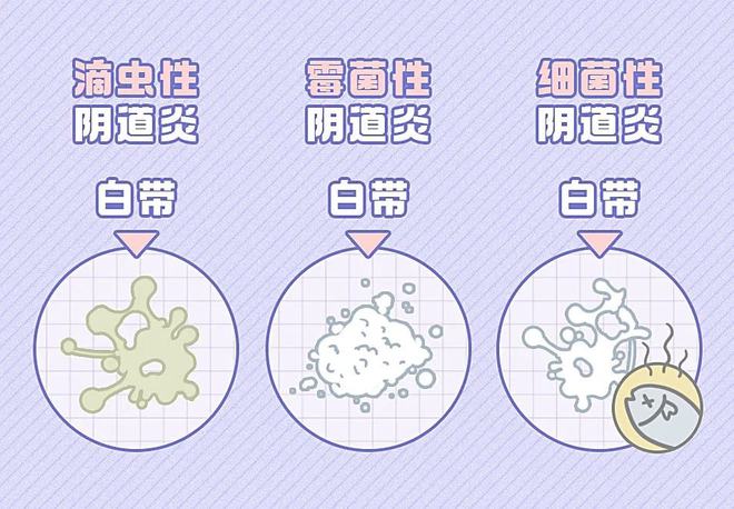 细菌性阴道炎的症状_(什么是细菌性阴炎症状图片)