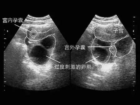 宫外孕的表现(宫外孕的表现症状有哪些,多少天能查出来)