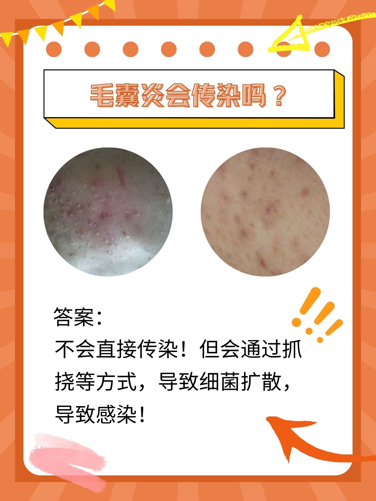 细菌感染会传染吗(肠胃细菌感染会传染吗)