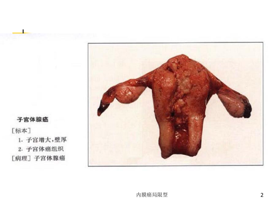 子宫内膜癌_(子宫内膜癌b超能看出来吗)