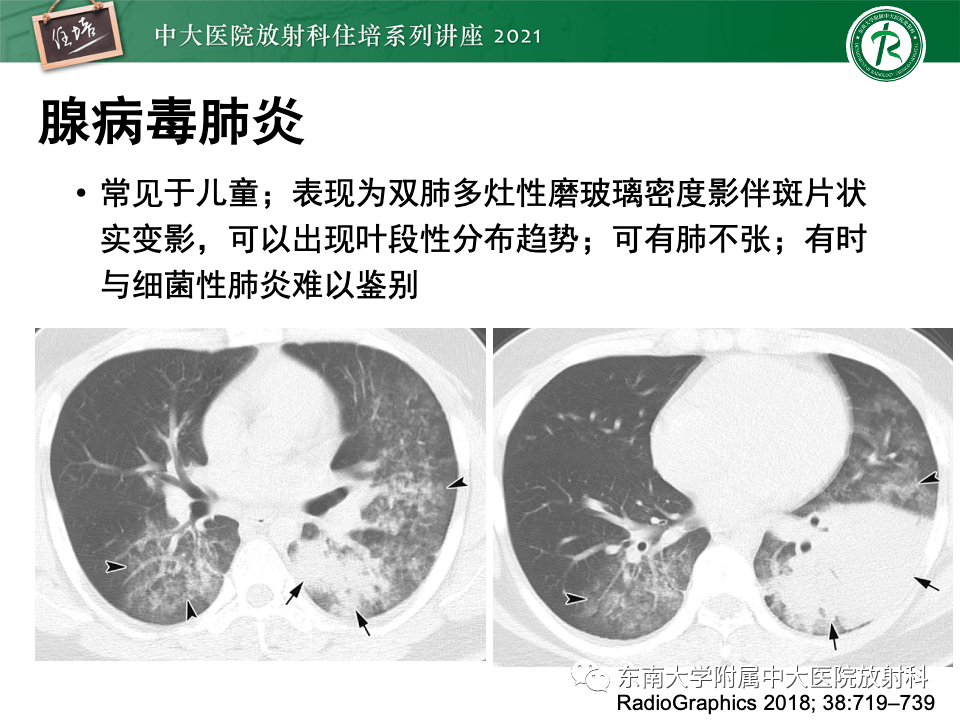 细菌性肺炎(细菌性肺炎会传染给别人吗)