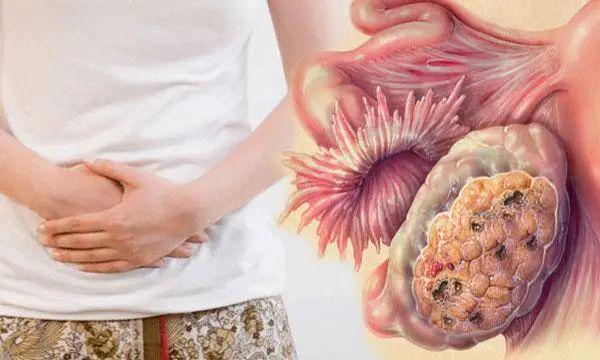 子宫癌的早期症状-(子宫内膜癌的早期症状)