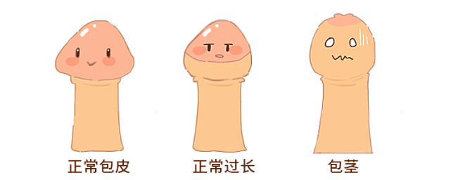 包皮过长图-(包皮过长图片)