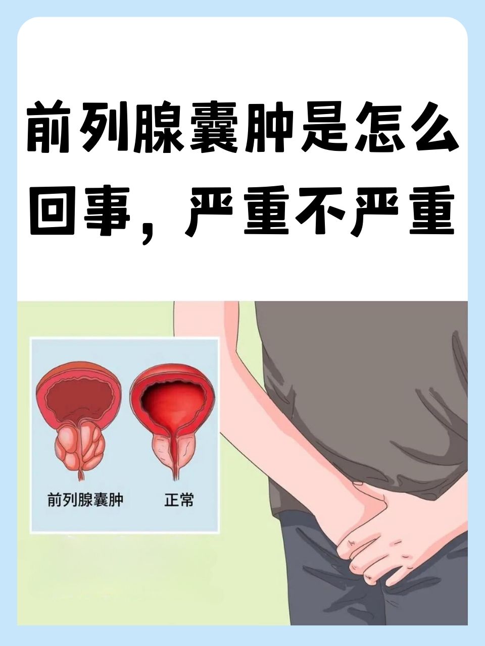 前列腺囊肿-(前列腺囊肿是怎么回事严重不严重)