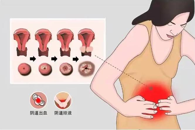 子宫肌瘤是什么原因导致的_(子宫肌瘤是什么造成的,该怎样治疗)