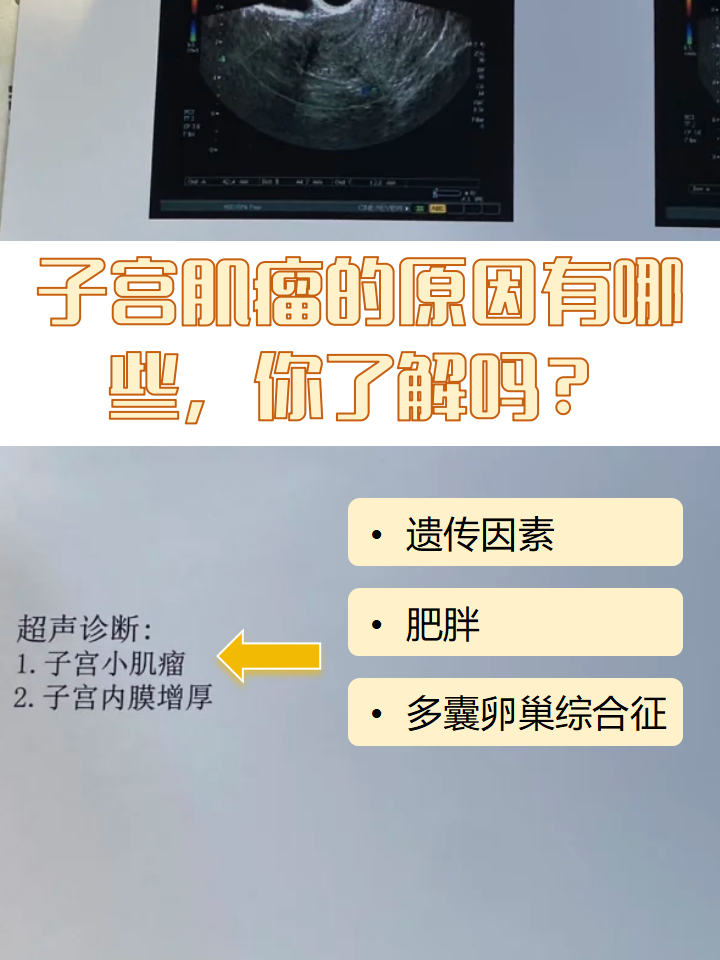 子宫肌瘤是什么原因导致的_(子宫肌瘤是什么造成的,该怎样治疗)