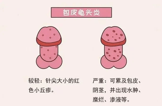 北京包皮-(北京包皮手术可以医保报销吗)