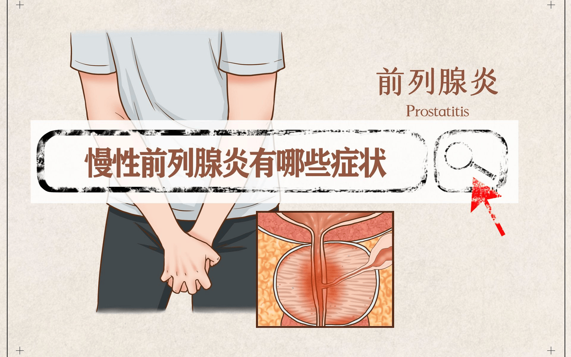 细菌性前列腺炎-(细菌性前列腺炎吃什么药)