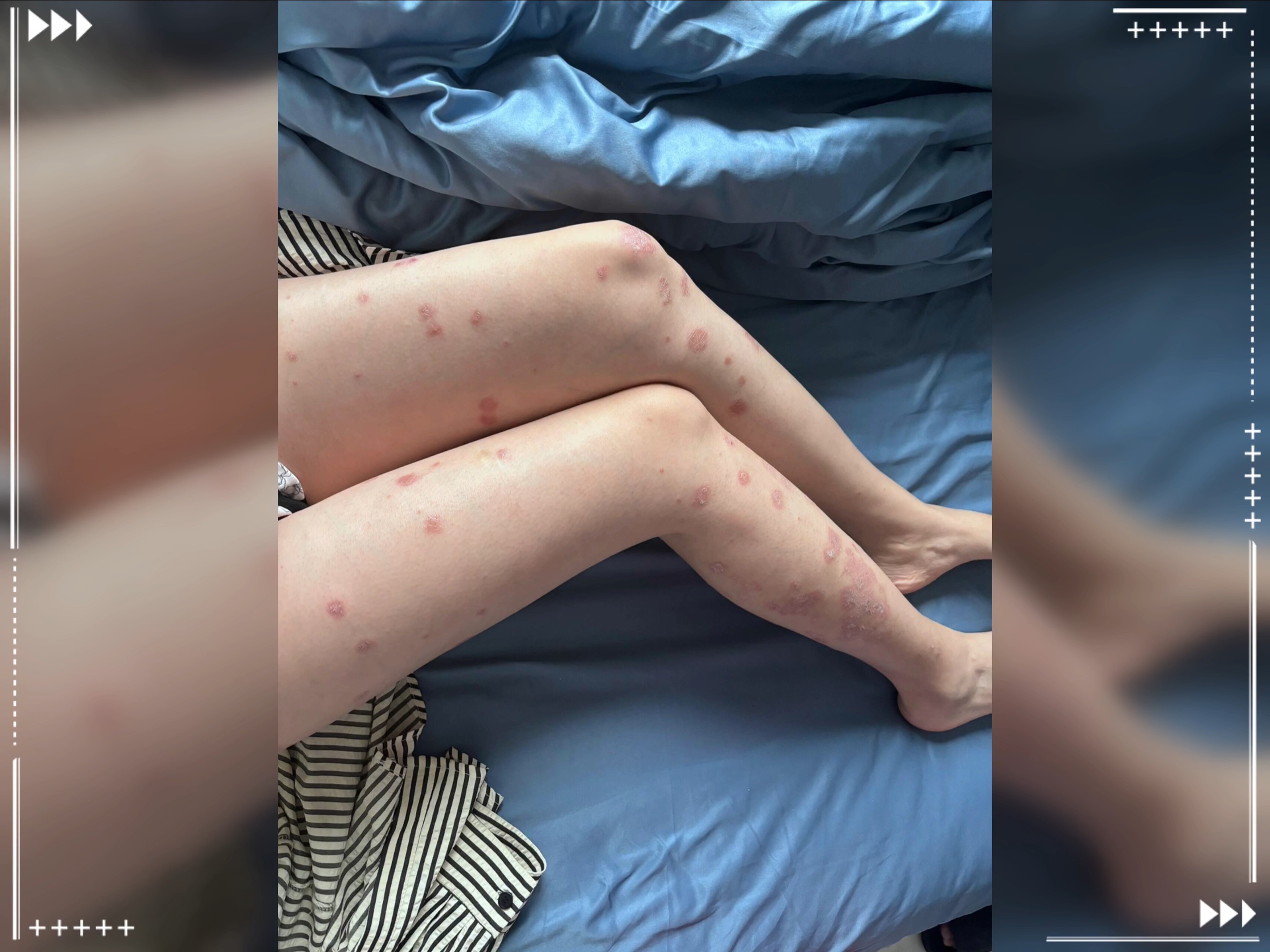 牛皮癣-(牛皮癣用什么药膏最好)