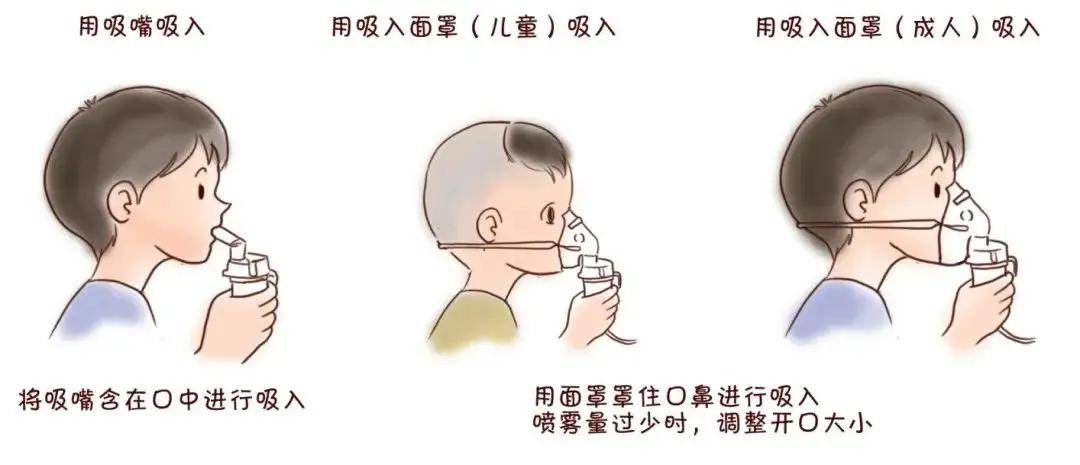 氨溴索雾化(氨溴索雾化副作用大吗)