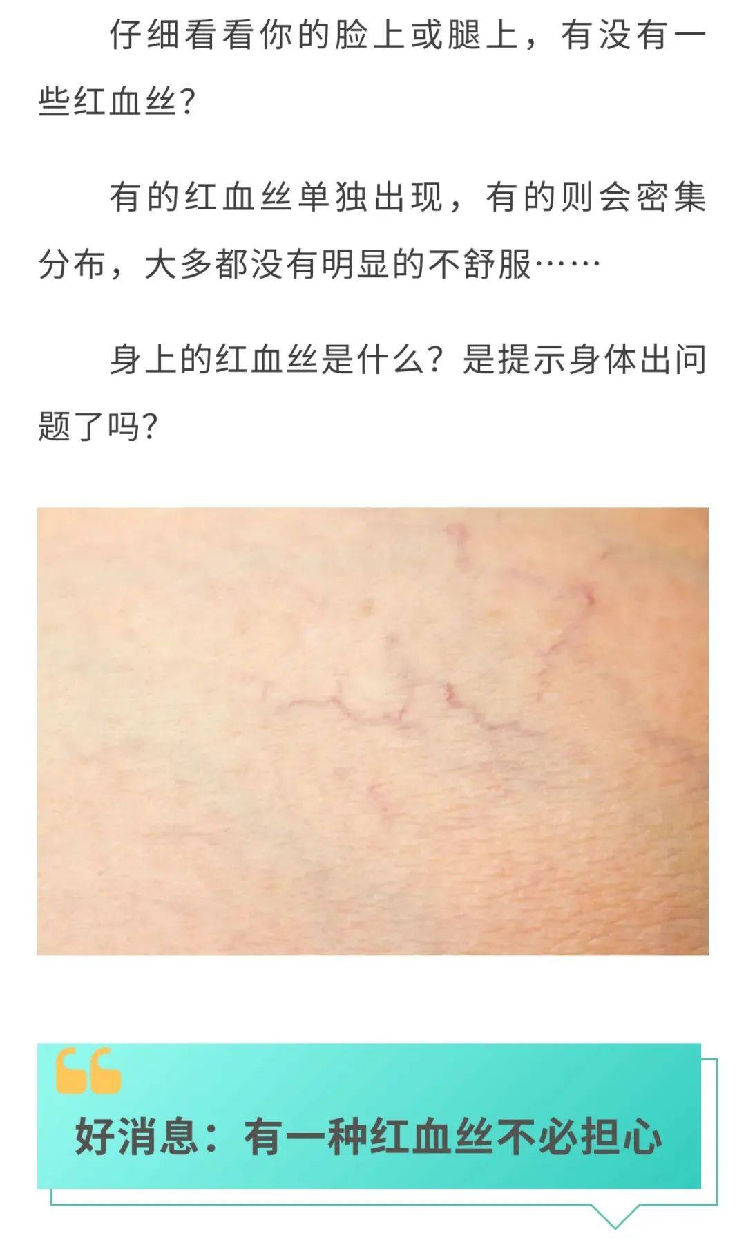 皮肤薄红血丝_(脸部角质层薄怎么修复还有红血丝)