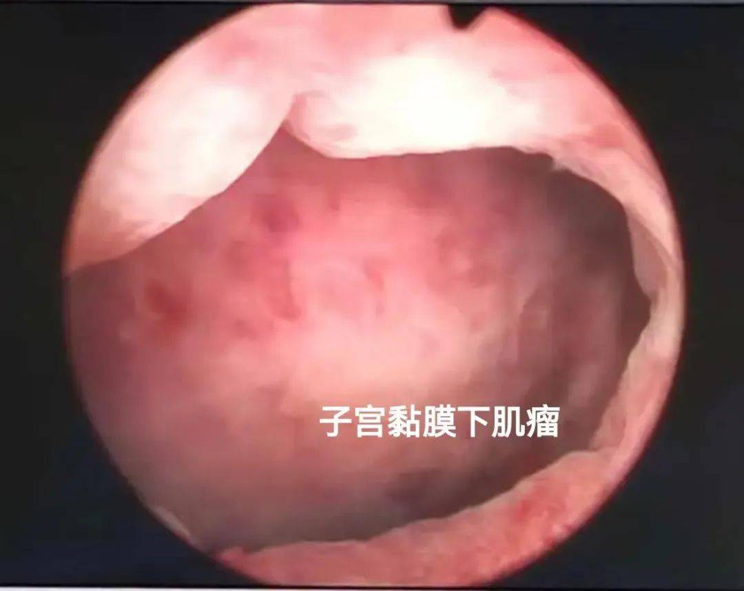 宫颈肌瘤_(宫颈肌瘤有必要手术吗)