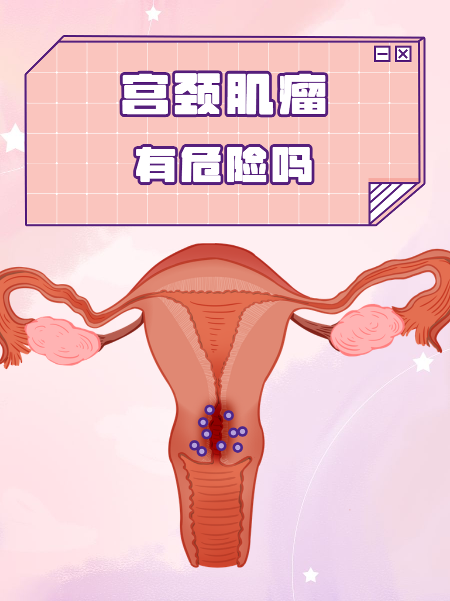 宫颈肌瘤_(宫颈肌瘤有必要手术吗)
