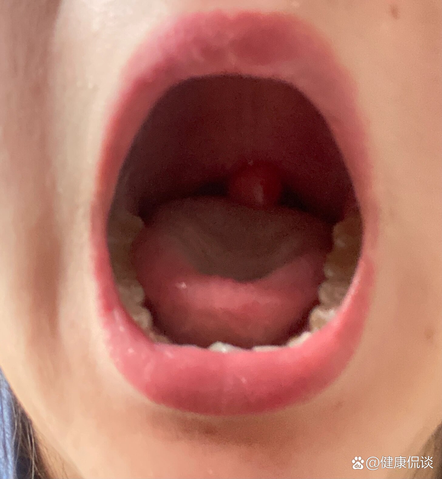 悬雍垂发炎_(悬雍垂发炎能自愈吗)