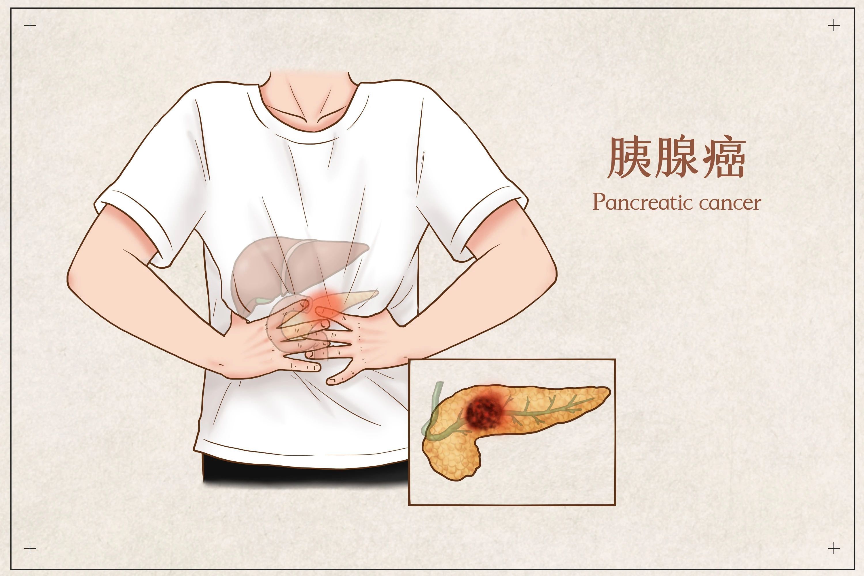 白陶土样便(大便陶土色如何辨别)
