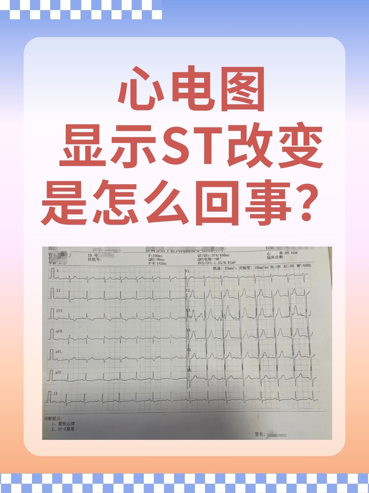 心电图正常_(心电图正常能证明心脏没问题吗)