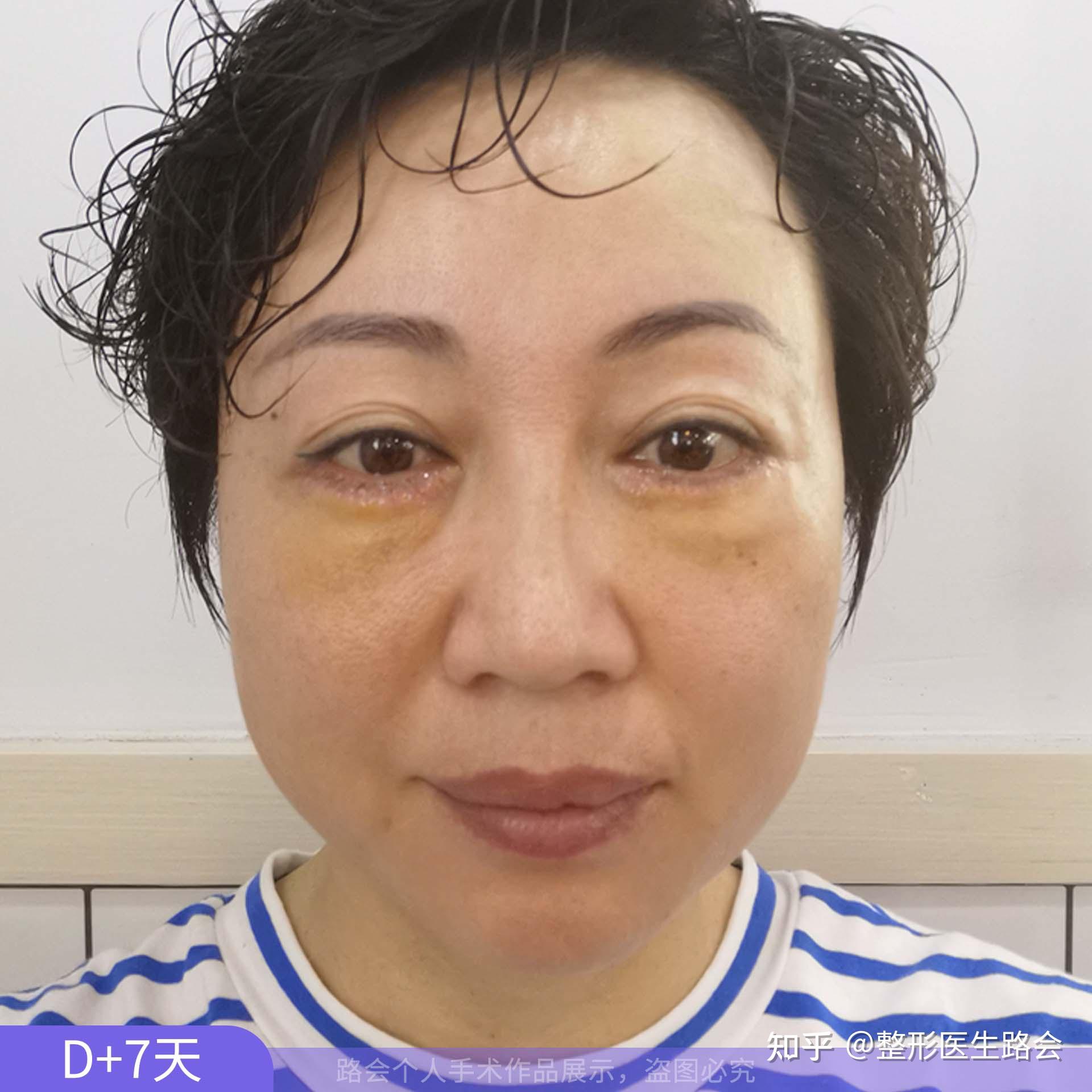 做泪沟手术多少钱(泪沟填充能维持几年)