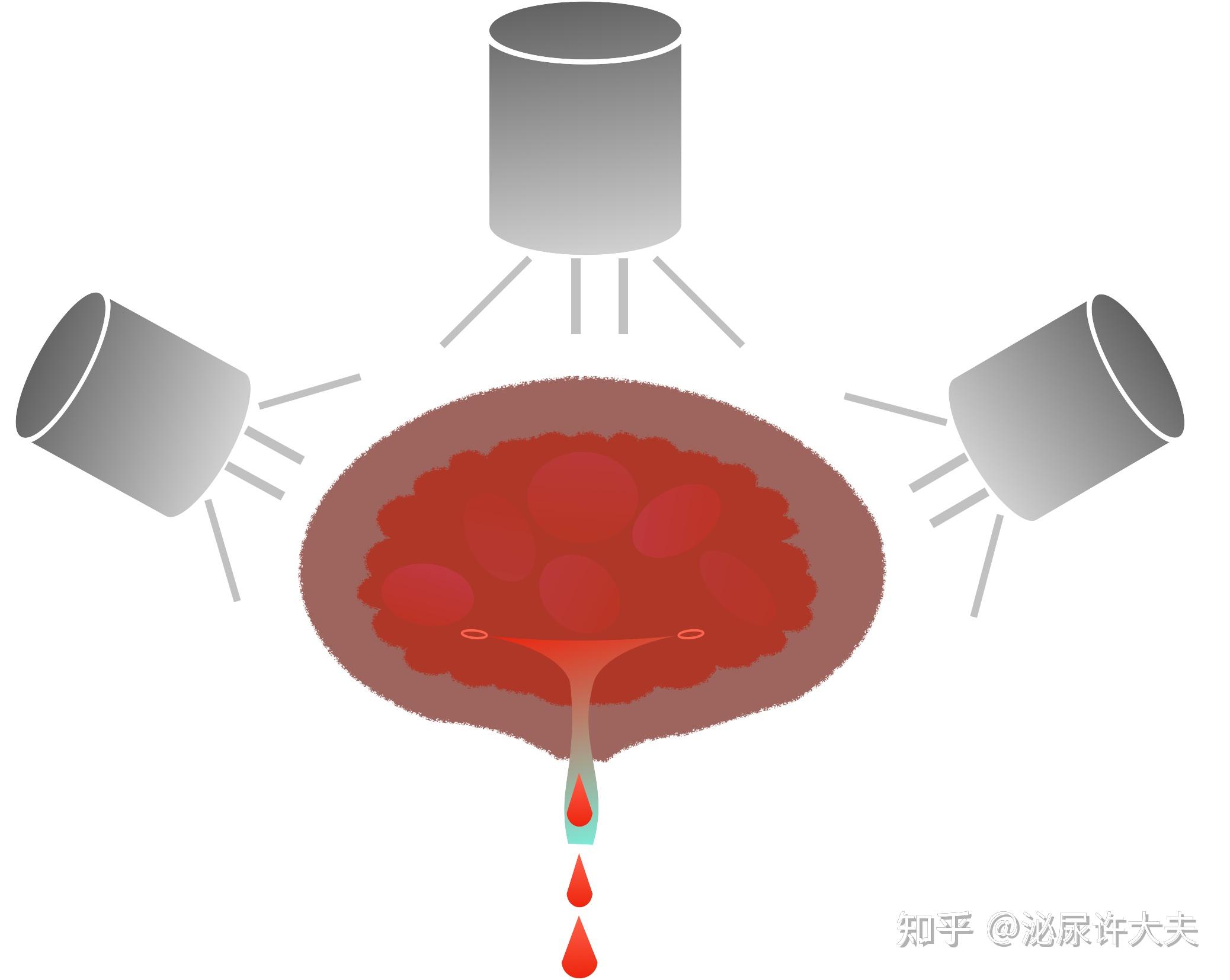 放射性膀胱炎(放射性膀胱炎的临床表现)