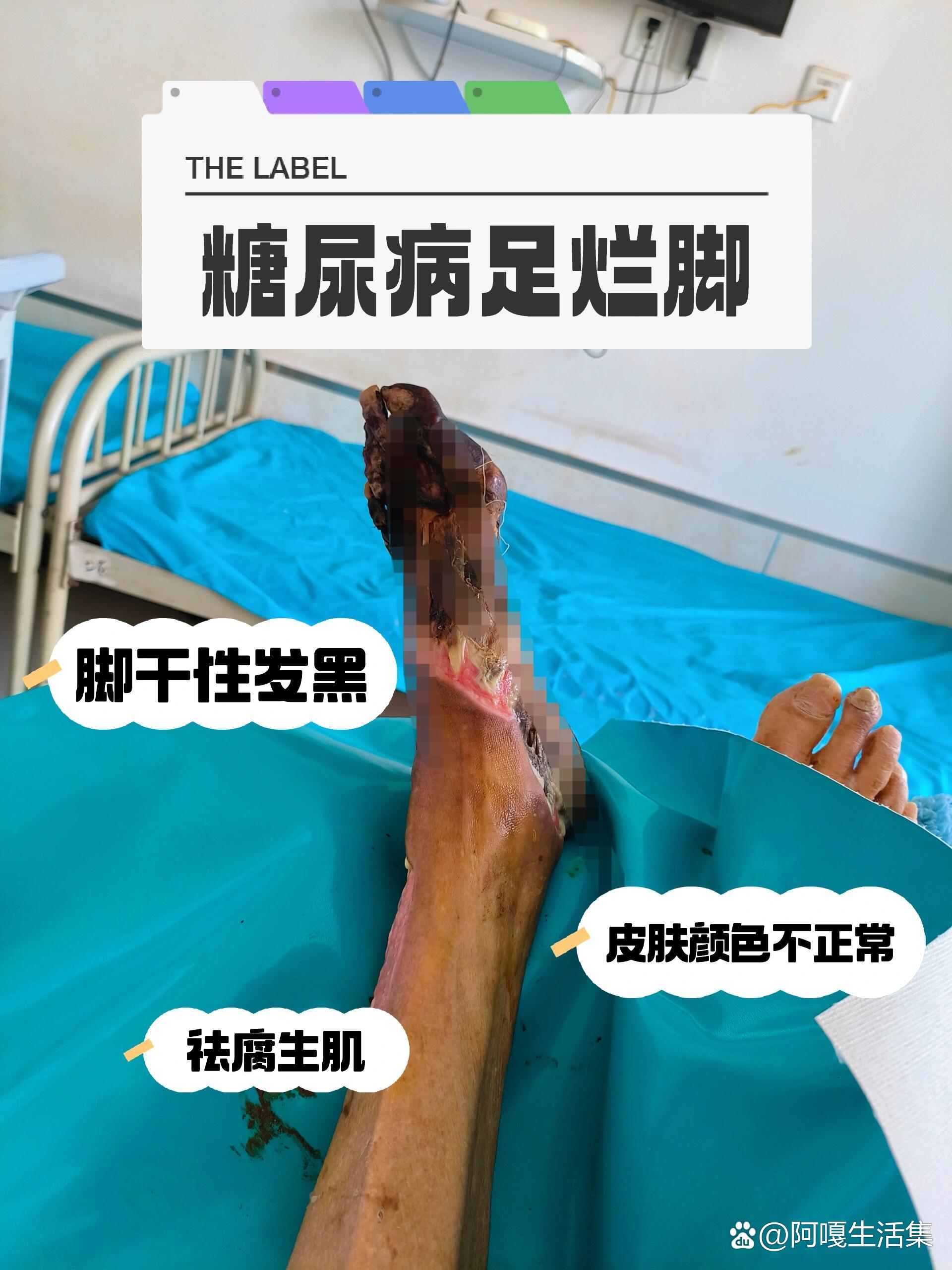 脚溃烂严重怎么办_(脚溃烂严重怎么办是什么病)