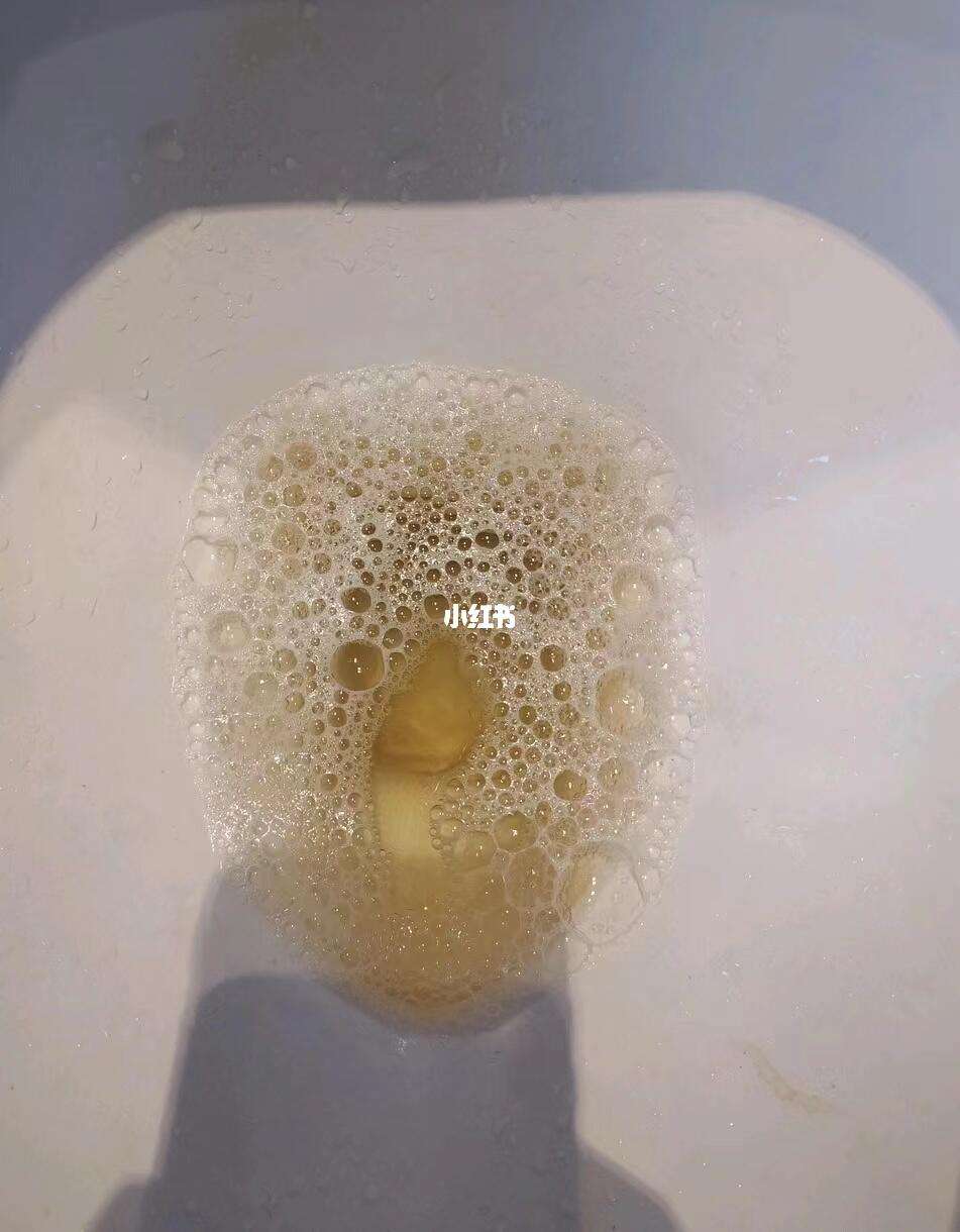 蛋白尿的症状-(蛋白尿的症状及危害?专家详解)