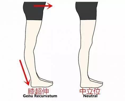 膝超伸是什么_(膝超伸是什么原因造成的)